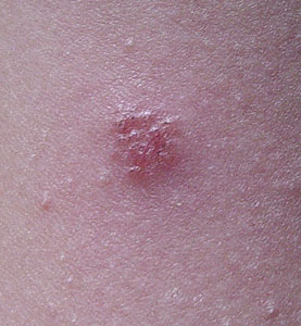 My bug bite is now a blister. How should I treat it? - WebMD