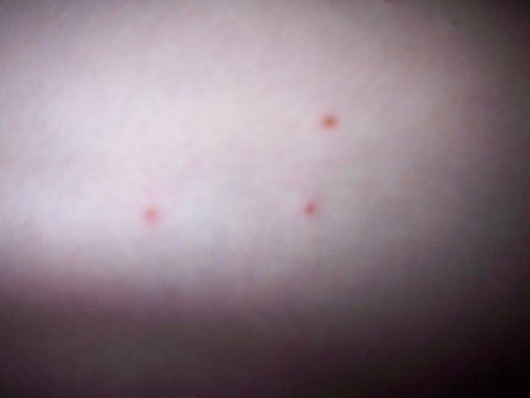 Chicken Pox Or Flea Bites http://www.momsview.com/discus/messages/41 ...