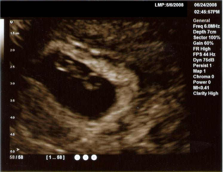 7-week ultrasound